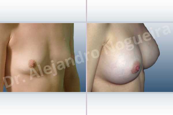 Asymmetric breasts,Lateral breasts,Skinny breasts,Small breasts,Too far apart wide cleavage breasts,Anatomical shape,Lower hemi periareolar incision,Subfascial pocket plane - photo 3