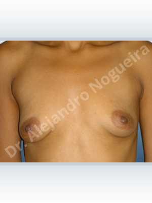 Asymmetric breasts,Cross eyed breasts,Empty breasts,Large areolas,Lateral breasts,Narrow breasts,Skinny breasts,Slightly saggy droopy breasts,Small breasts,Too far apart wide cleavage breasts,Tuberous breasts,Anatomical shape,Lower hemi periareolar incision,Subfascial pocket plane,Tuberous mammoplasty,Extra large size