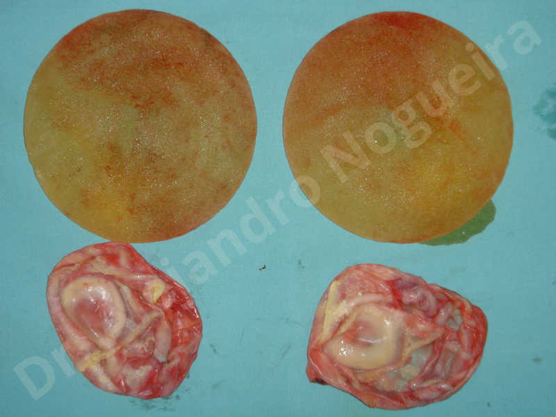 Breast implants capsular contracture,Breast implants capsule calcification,Breast implants displacement malposition,Breast implants riding too high,Broken breast implants,Empty breasts,Slightly saggy droopy breasts,Too far apart wide cleavage breast implants,Too far apart wide cleavage breasts,Too narrow breast implants,Waterfall effect breast implants,Capsulectomy - photo 2