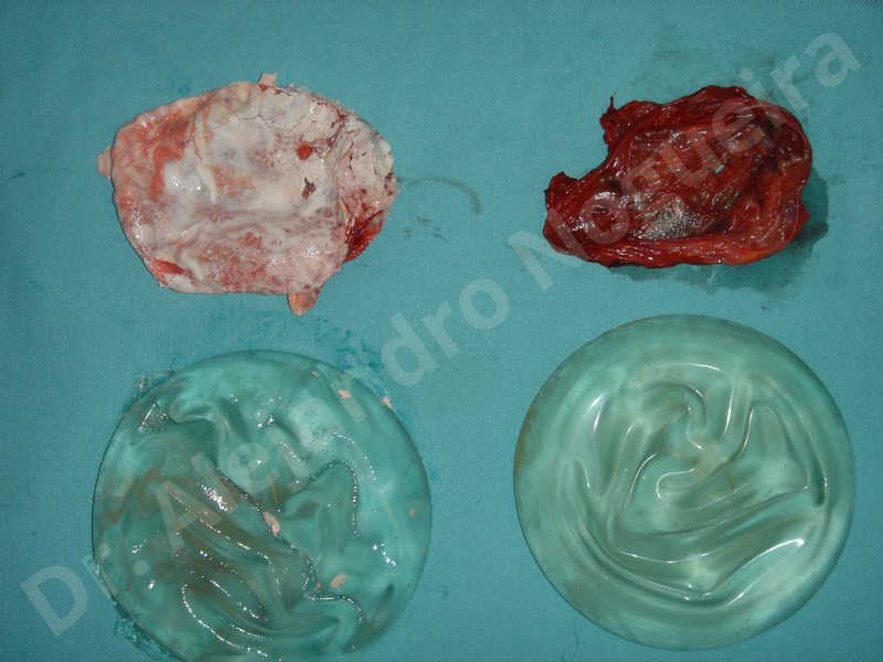 Asymmetric breasts,Breast implants animation muscle flex deformity,Breast implants capsular contracture,Breast implants capsule calcification,Breast implants displacement malposition,Breast implants visibility palpability,Broken breast implants,Cross eyed breasts implants,Empty breasts,Too far apart wide cleavage breast implants,Too narrow breast implants,Capsulectomy - photo 3