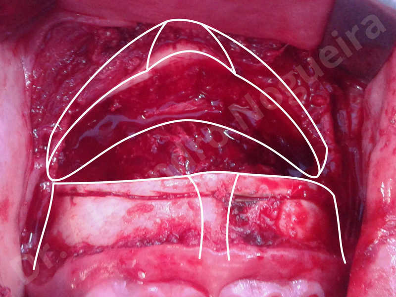 Large chin,Transgender chin,Horizontal chin osteotomy,Horizontal osseous chin resection,Two dimensional genioplasty,Vertical osseous chin resection - photo 10