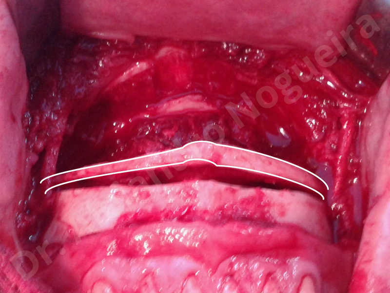 Large chin,Transgender chin,Horizontal chin osteotomy,Horizontal osseous chin resection,Two dimensional genioplasty,Vertical osseous chin resection - photo 12