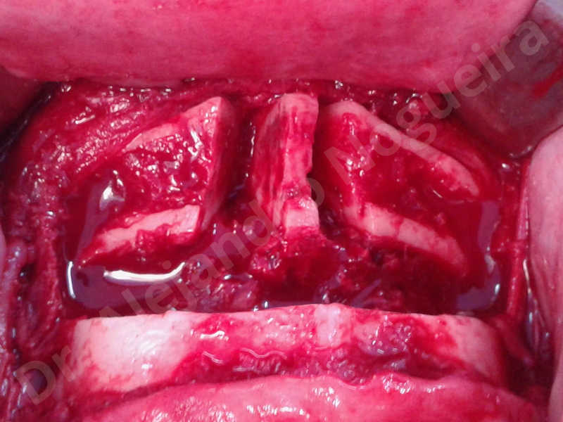 Large chin,Transgender chin,Horizontal chin osteotomy,Horizontal osseous chin resection,Two dimensional genioplasty,Vertical osseous chin resection - photo 15