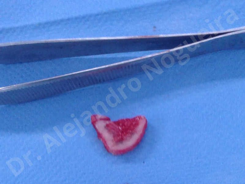 Large chin,Transgender chin,Horizontal chin osteotomy,Horizontal osseous chin resection,Two dimensional genioplasty,Vertical osseous chin resection - photo 17