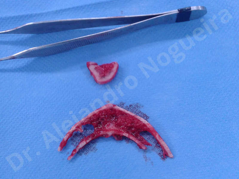 Large chin,Transgender chin,Horizontal chin osteotomy,Horizontal osseous chin resection,Two dimensional genioplasty,Vertical osseous chin resection - photo 18