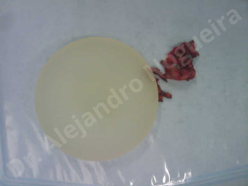Breast implants capsular contracture,Breast implants capsule calcification,Breast implants displacement malposition,Breast implants riding too high,Broken breast implants,Capsulectomy - photo 2