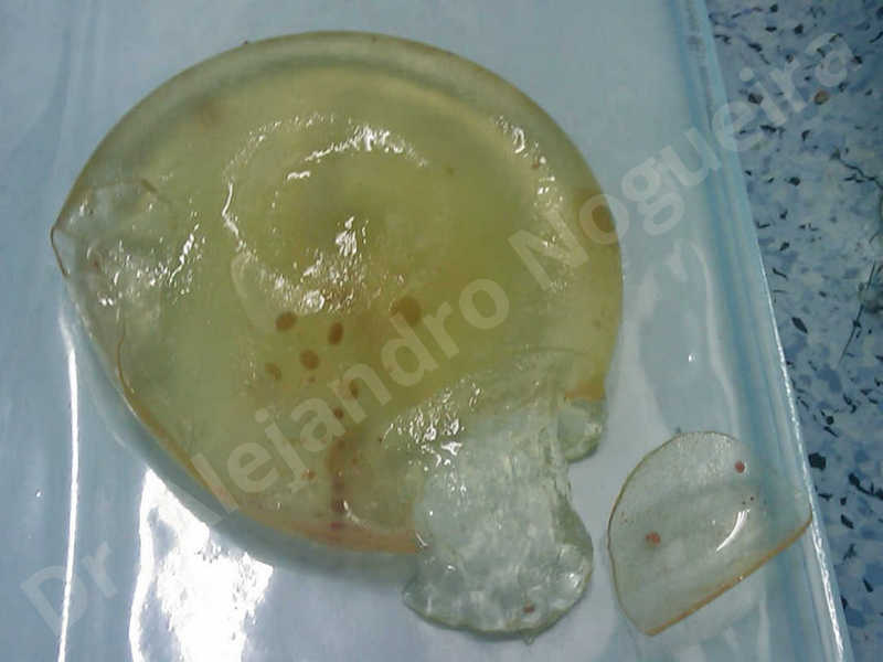 Breast implants capsular contracture,Breast implants capsule calcification,Breast implants displacement malposition,Breast implants riding too high,Broken breast implants,Capsulectomy - photo 4