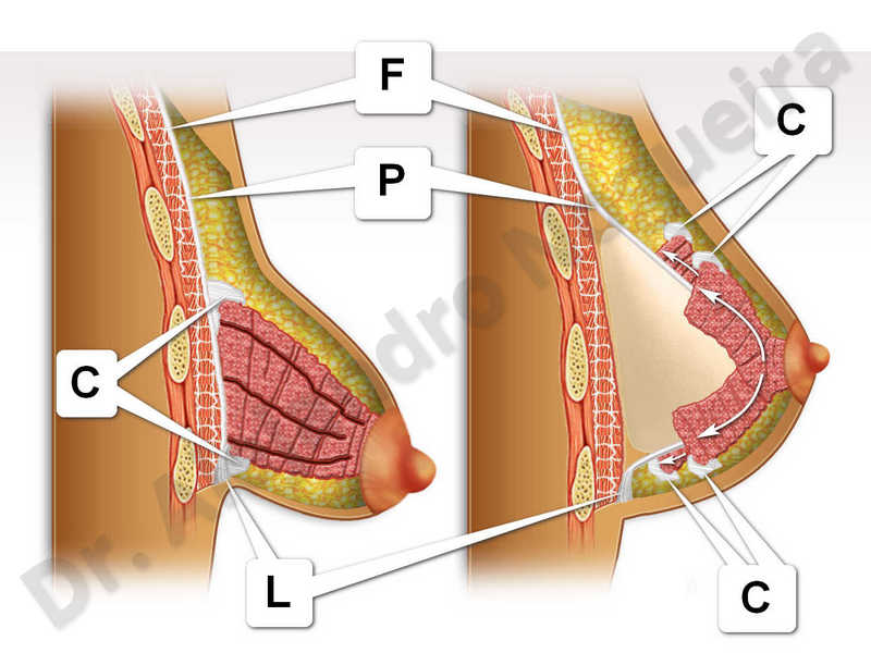 Large areolas,Tuberous breasts,Areola reduction,Tuberous mammoplasty - photo 1