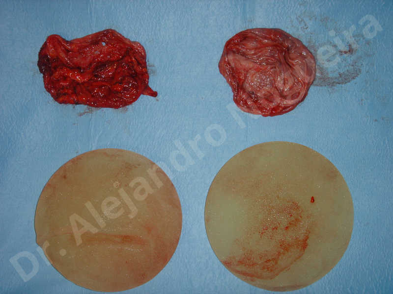 Breast implants animation muscle flex deformity,Breast implants capsular contracture,Breast implants double bubble deformity,Breast implants excessive movement,Sunken scars,Capsulectomy - photo 2