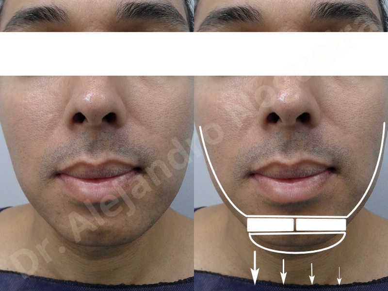 Small chin,Weak chin,Oblique chin osteotomy,Elbow bone graft harvesting,Osseous chin advancement,Two dimensional genioplasty,Vertical osseous chin grafting - photo 1