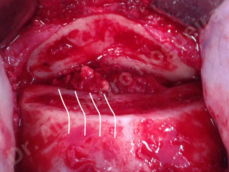 Small chin,Weak chin,Oblique chin osteotomy,Elbow bone graft harvesting,Osseous chin advancement,Two dimensional genioplasty,Vertical osseous chin grafting - photo 10