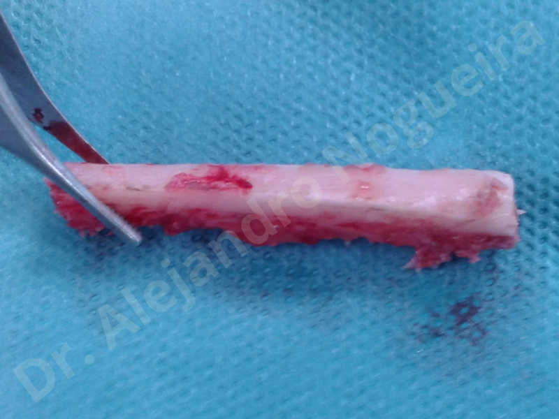 Small chin,Weak chin,Oblique chin osteotomy,Elbow bone graft harvesting,Osseous chin advancement,Two dimensional genioplasty,Vertical osseous chin grafting - photo 15