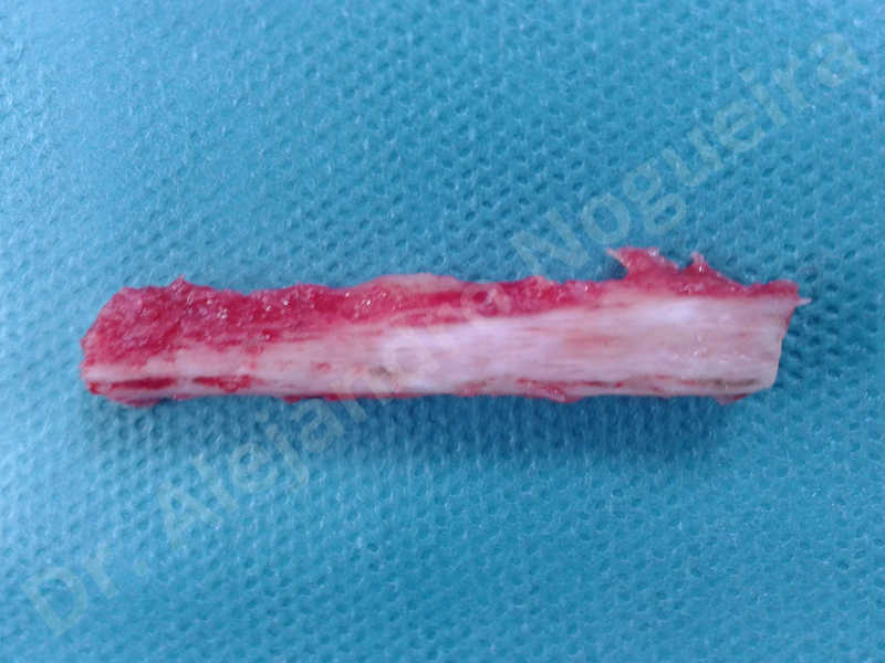 Small chin,Weak chin,Oblique chin osteotomy,Elbow bone graft harvesting,Osseous chin advancement,Two dimensional genioplasty,Vertical osseous chin grafting - photo 17