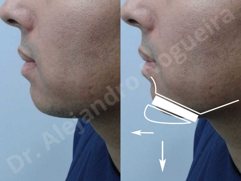 Small chin,Weak chin,Oblique chin osteotomy,Elbow bone graft harvesting,Osseous chin advancement,Two dimensional genioplasty,Vertical osseous chin grafting - photo 2