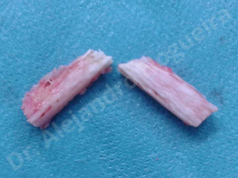 Small chin,Weak chin,Oblique chin osteotomy,Elbow bone graft harvesting,Osseous chin advancement,Two dimensional genioplasty,Vertical osseous chin grafting - photo 21
