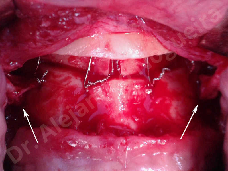 Small chin,Weak chin,Oblique chin osteotomy,Elbow bone graft harvesting,Osseous chin advancement,Two dimensional genioplasty,Vertical osseous chin grafting - photo 32