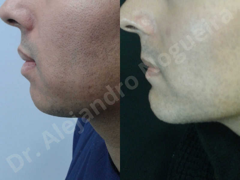 Small chin,Weak chin,Oblique chin osteotomy,Elbow bone graft harvesting,Osseous chin advancement,Two dimensional genioplasty,Vertical osseous chin grafting - photo 34