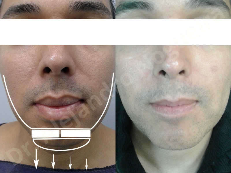 Small chin,Weak chin,Oblique chin osteotomy,Elbow bone graft harvesting,Osseous chin advancement,Two dimensional genioplasty,Vertical osseous chin grafting - photo 35