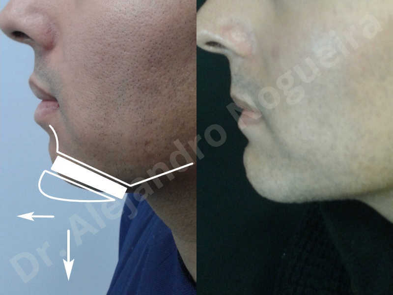 Small chin,Weak chin,Oblique chin osteotomy,Elbow bone graft harvesting,Osseous chin advancement,Two dimensional genioplasty,Vertical osseous chin grafting - photo 36