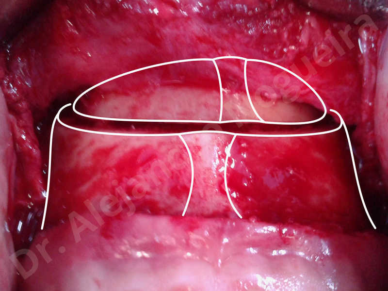 Small chin,Weak chin,Oblique chin osteotomy,Elbow bone graft harvesting,Osseous chin advancement,Two dimensional genioplasty,Vertical osseous chin grafting - photo 5