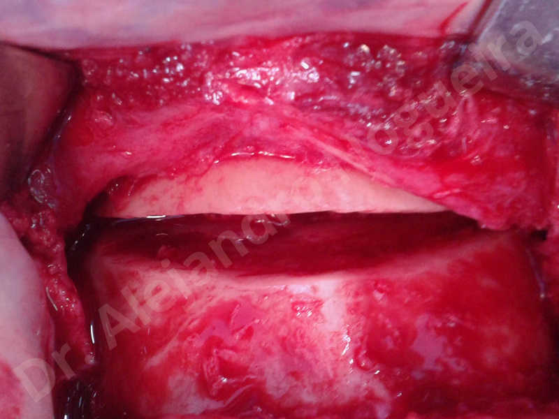 Small chin,Weak chin,Oblique chin osteotomy,Elbow bone graft harvesting,Osseous chin advancement,Two dimensional genioplasty,Vertical osseous chin grafting - photo 6