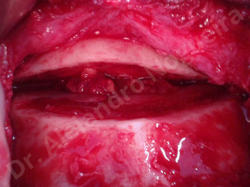 Small chin,Weak chin,Oblique chin osteotomy,Elbow bone graft harvesting,Osseous chin advancement,Two dimensional genioplasty,Vertical osseous chin grafting - photo 7