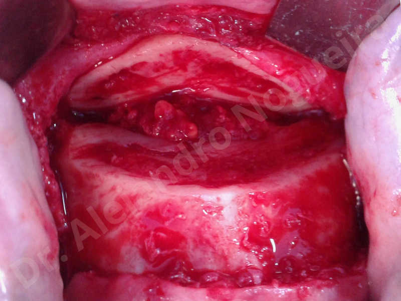 Small chin,Weak chin,Oblique chin osteotomy,Elbow bone graft harvesting,Osseous chin advancement,Two dimensional genioplasty,Vertical osseous chin grafting - photo 9