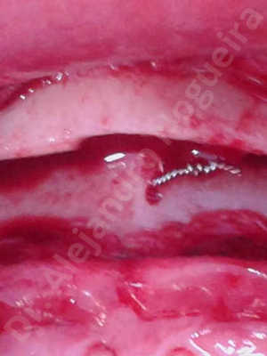 Large chin,Weak chin,Oblique chin osteotomy,Osseous chin advancement,Two dimensional genioplasty