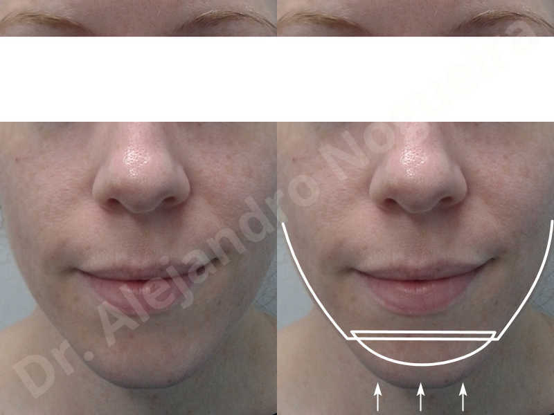 Large chin,Weak chin,Oblique chin osteotomy,Osseous chin advancement,Two dimensional genioplasty - photo 1