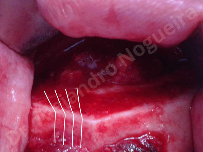 Large chin,Weak chin,Oblique chin osteotomy,Osseous chin advancement,Two dimensional genioplasty - photo 10