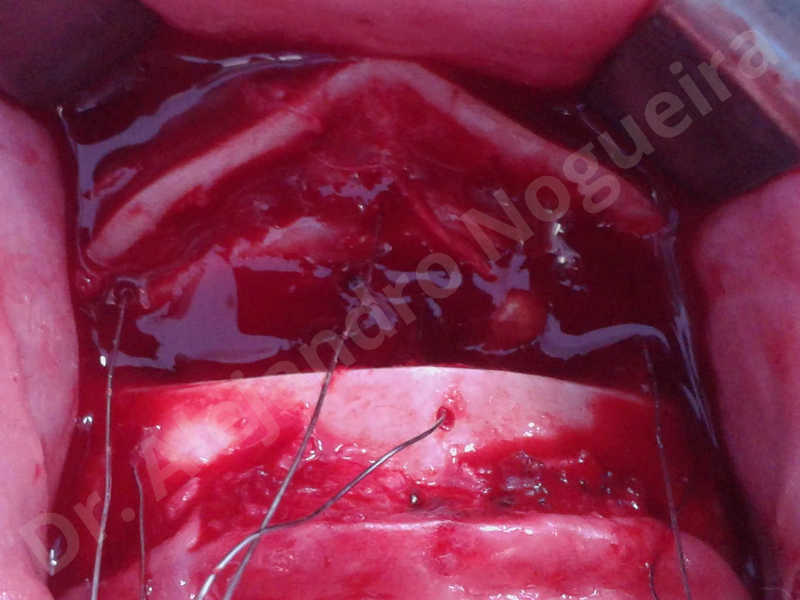 Large chin,Weak chin,Oblique chin osteotomy,Osseous chin advancement,Two dimensional genioplasty - photo 11