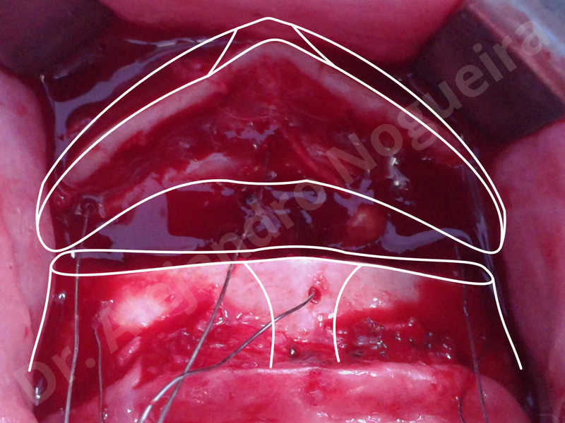Large chin,Weak chin,Oblique chin osteotomy,Osseous chin advancement,Two dimensional genioplasty - photo 12