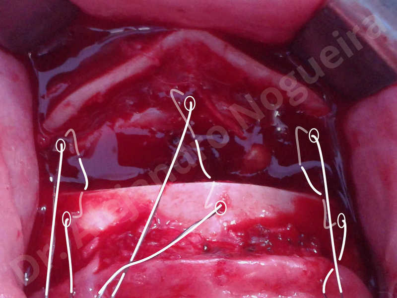 Large chin,Weak chin,Oblique chin osteotomy,Osseous chin advancement,Two dimensional genioplasty - photo 13