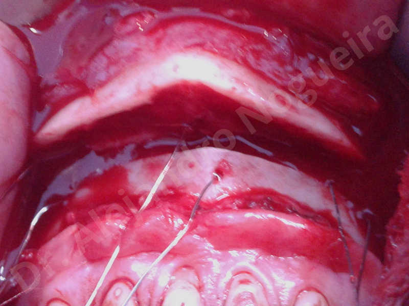 Large chin,Weak chin,Oblique chin osteotomy,Osseous chin advancement,Two dimensional genioplasty - photo 14