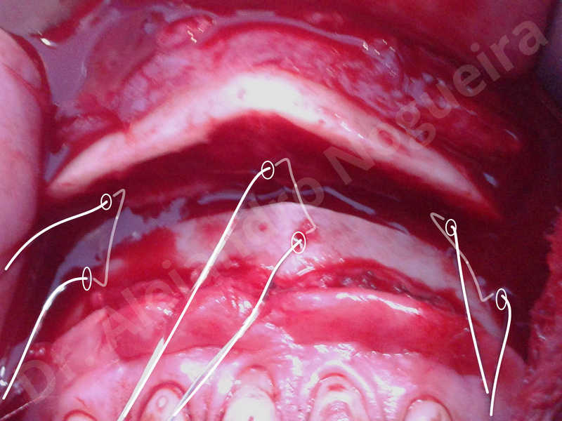 Large chin,Weak chin,Oblique chin osteotomy,Osseous chin advancement,Two dimensional genioplasty - photo 16