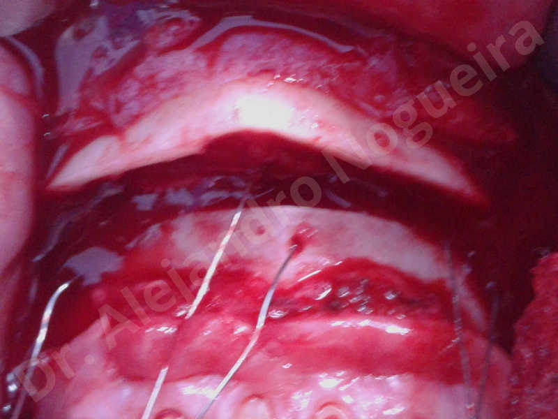 Large chin,Weak chin,Oblique chin osteotomy,Osseous chin advancement,Two dimensional genioplasty - photo 17