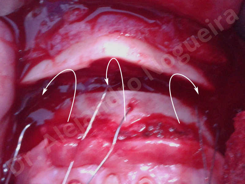Large chin,Weak chin,Oblique chin osteotomy,Osseous chin advancement,Two dimensional genioplasty - photo 18