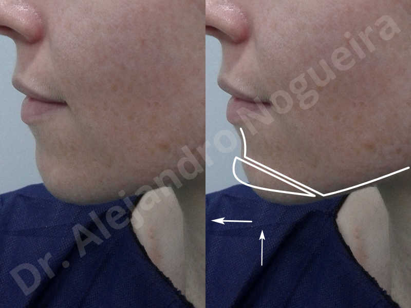 Large chin,Weak chin,Oblique chin osteotomy,Osseous chin advancement,Two dimensional genioplasty - photo 2