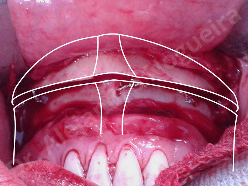 Large chin,Weak chin,Oblique chin osteotomy,Osseous chin advancement,Two dimensional genioplasty - photo 20