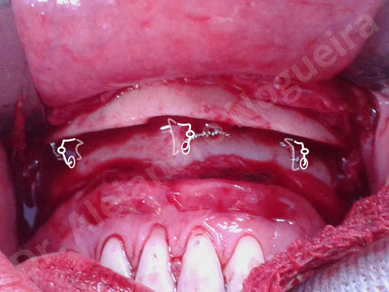 Large chin,Weak chin,Oblique chin osteotomy,Osseous chin advancement,Two dimensional genioplasty - photo 21