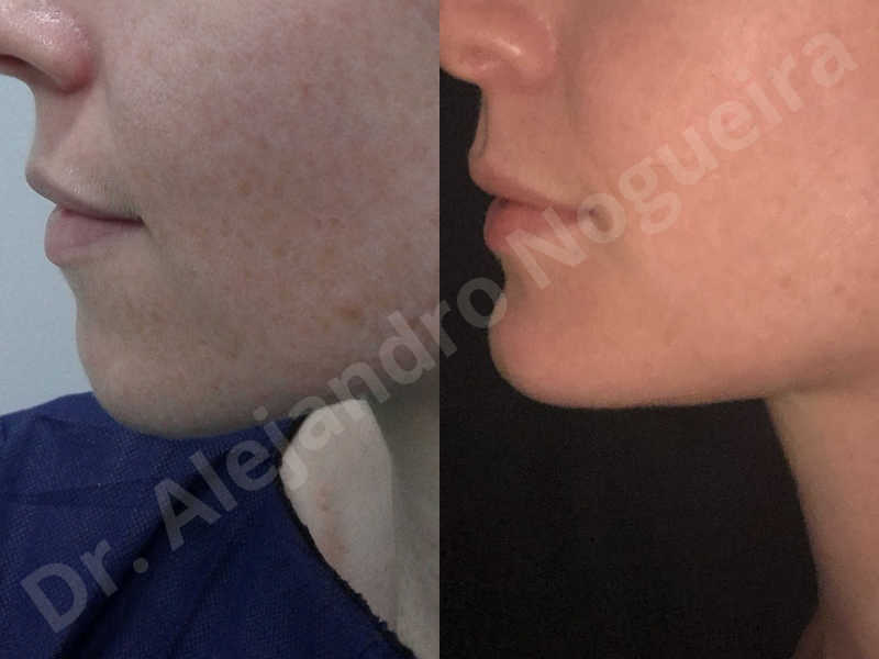 Large chin,Weak chin,Oblique chin osteotomy,Osseous chin advancement,Two dimensional genioplasty - photo 23