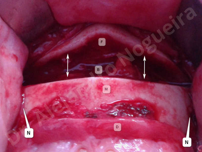 Large chin,Weak chin,Oblique chin osteotomy,Osseous chin advancement,Two dimensional genioplasty - photo 7