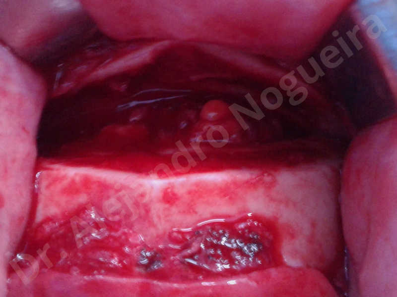 Large chin,Weak chin,Oblique chin osteotomy,Osseous chin advancement,Two dimensional genioplasty - photo 8