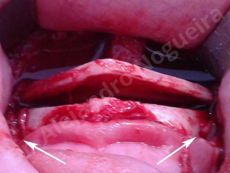Large chin,Prominent chin,Horizontal osseous chin resection,Oblique chin osteotomy,Osseous chin setback,Three dimensional genioplasty,Vertical osseous chin resection - photo 11