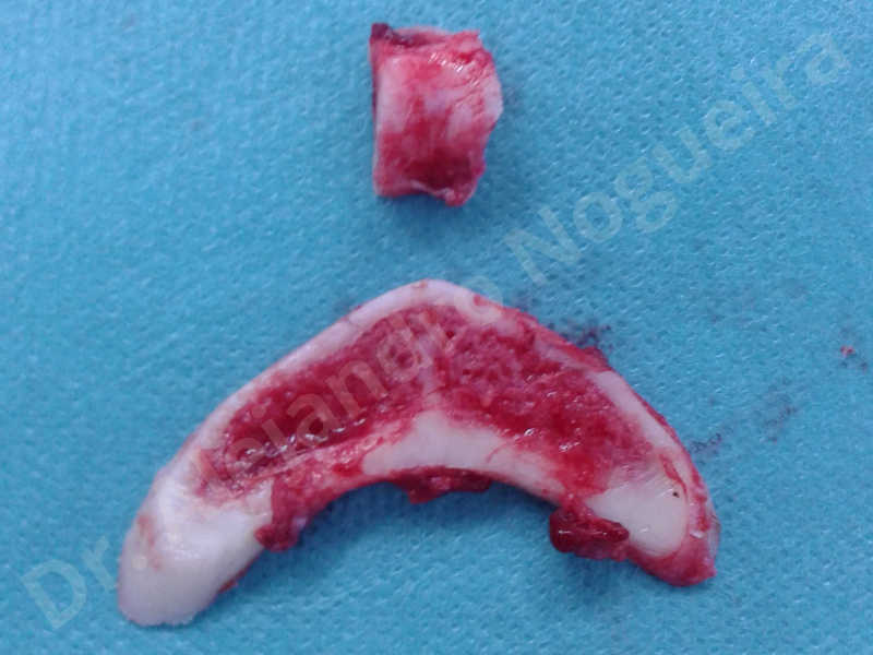 Large chin,Prominent chin,Horizontal osseous chin resection,Oblique chin osteotomy,Osseous chin setback,Three dimensional genioplasty,Vertical osseous chin resection - photo 14