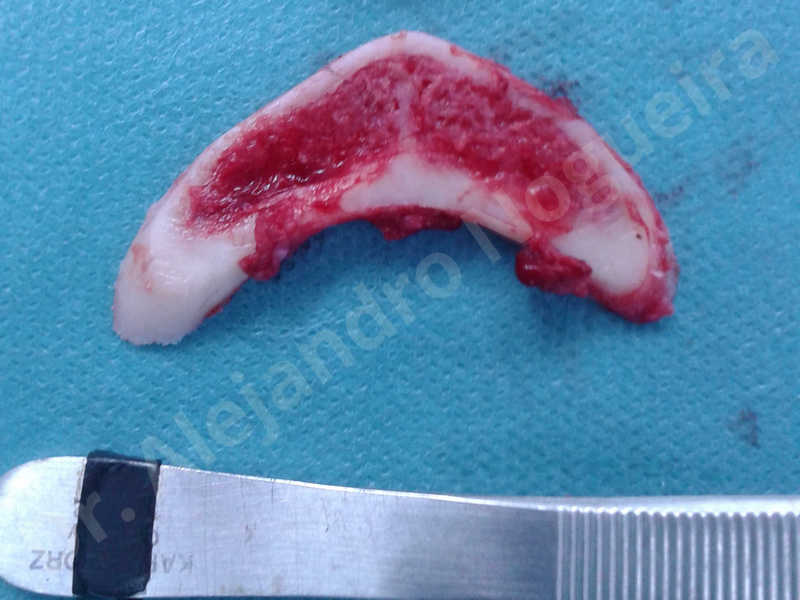 Large chin,Prominent chin,Horizontal osseous chin resection,Oblique chin osteotomy,Osseous chin setback,Three dimensional genioplasty,Vertical osseous chin resection - photo 16
