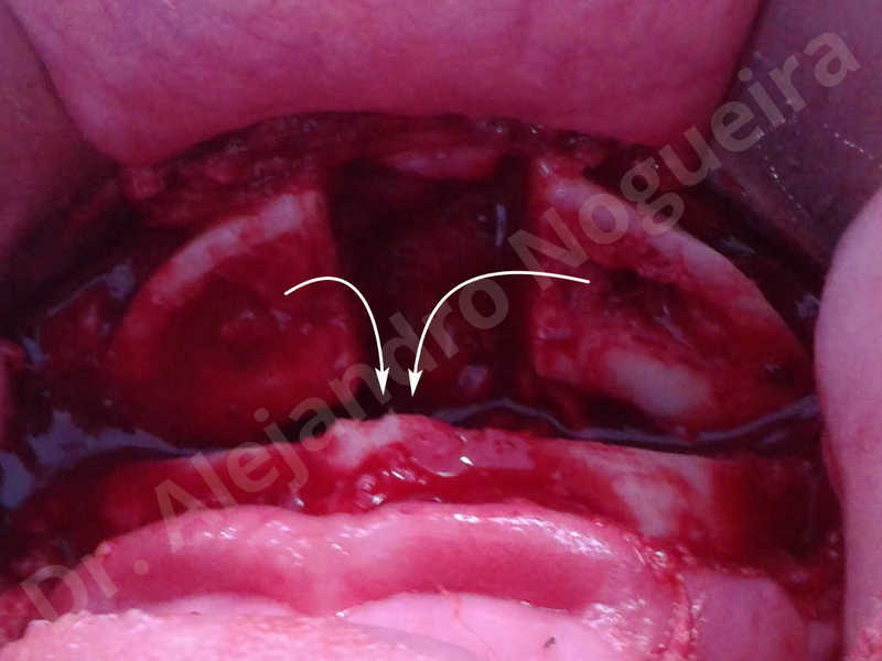 Large chin,Prominent chin,Horizontal osseous chin resection,Oblique chin osteotomy,Osseous chin setback,Three dimensional genioplasty,Vertical osseous chin resection - photo 17