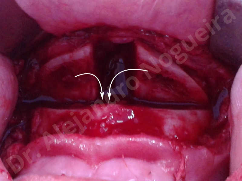 Large chin,Prominent chin,Horizontal osseous chin resection,Oblique chin osteotomy,Osseous chin setback,Three dimensional genioplasty,Vertical osseous chin resection - photo 18