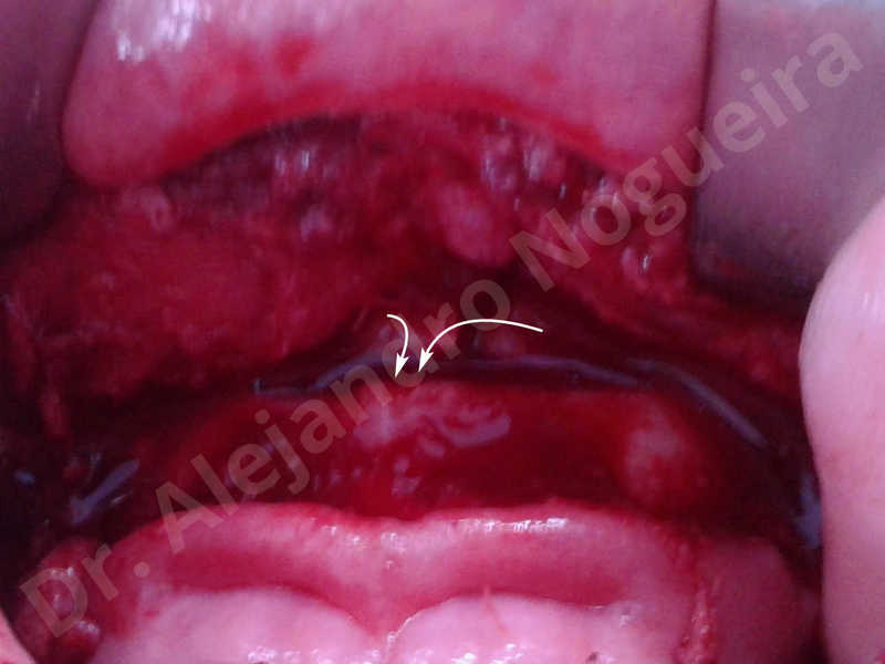 Large chin,Prominent chin,Horizontal osseous chin resection,Oblique chin osteotomy,Osseous chin setback,Three dimensional genioplasty,Vertical osseous chin resection - photo 20