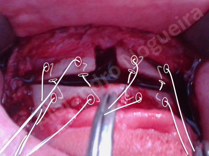 Large chin,Prominent chin,Horizontal osseous chin resection,Oblique chin osteotomy,Osseous chin setback,Three dimensional genioplasty,Vertical osseous chin resection - photo 22